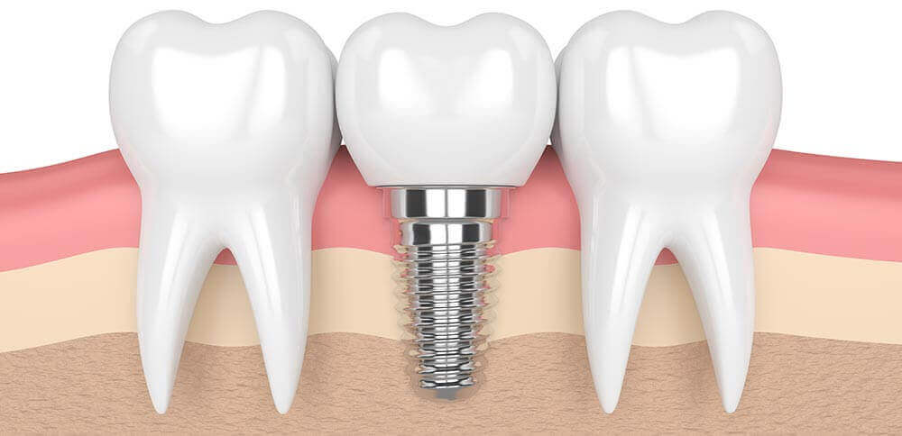 Couronnes dentaire à Bordeaux : implants dentaires